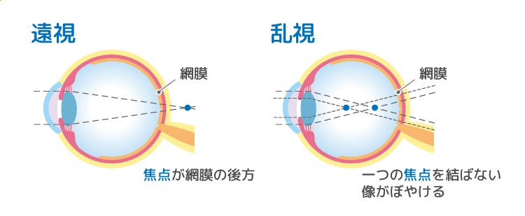 遠視、乱視