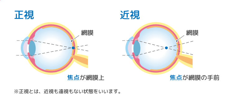 コンタクト すると 近く が 見え ない