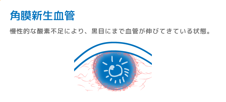 角膜新生血管症例のイメージ図