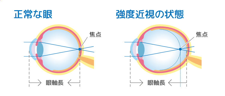 正常な目・強度近視の目