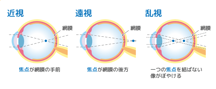 近視・遠視・乱視